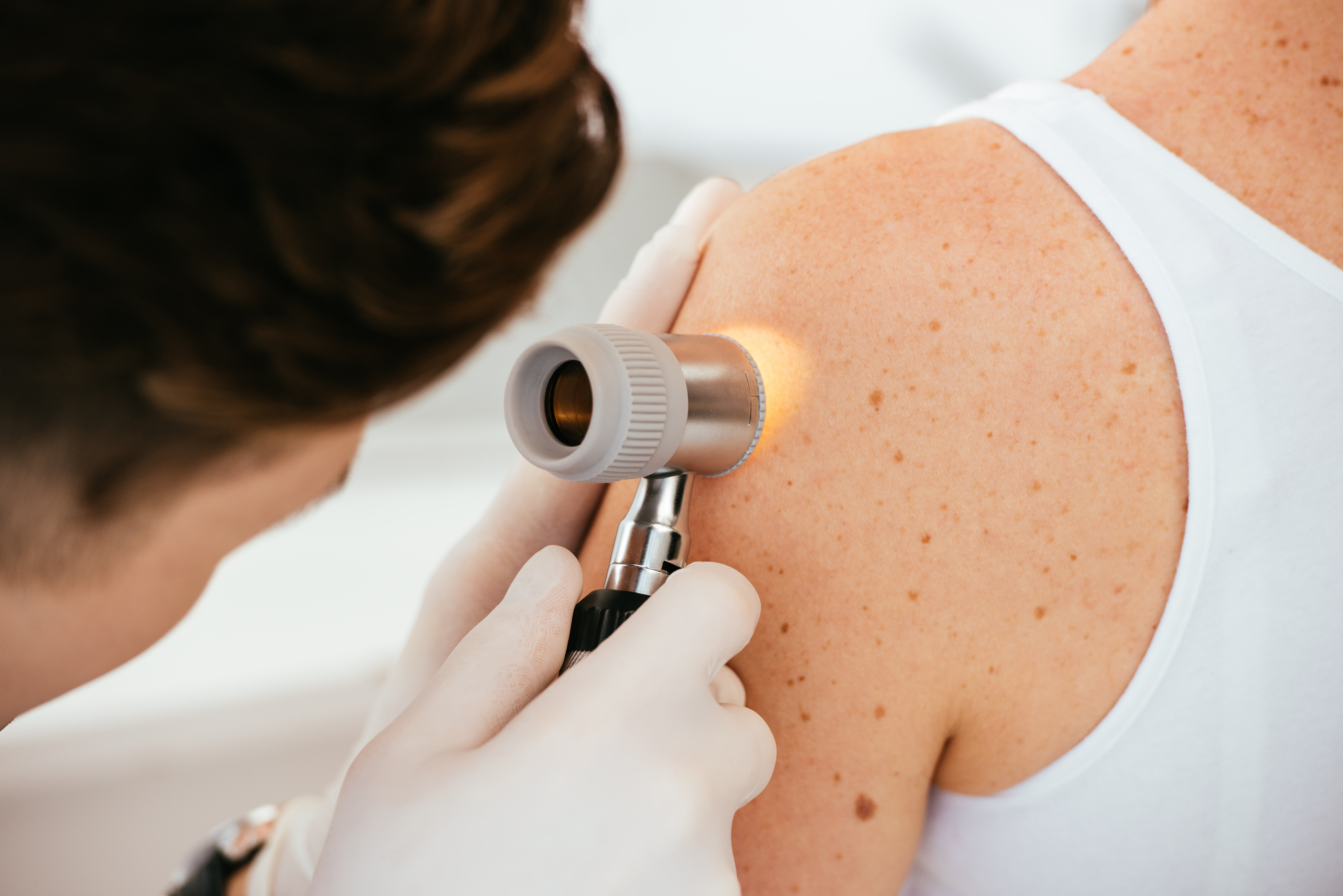 Melanoma care at CU Medicine