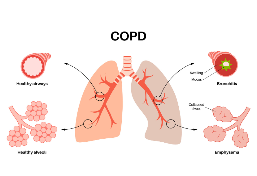 cu-medicine-copd
