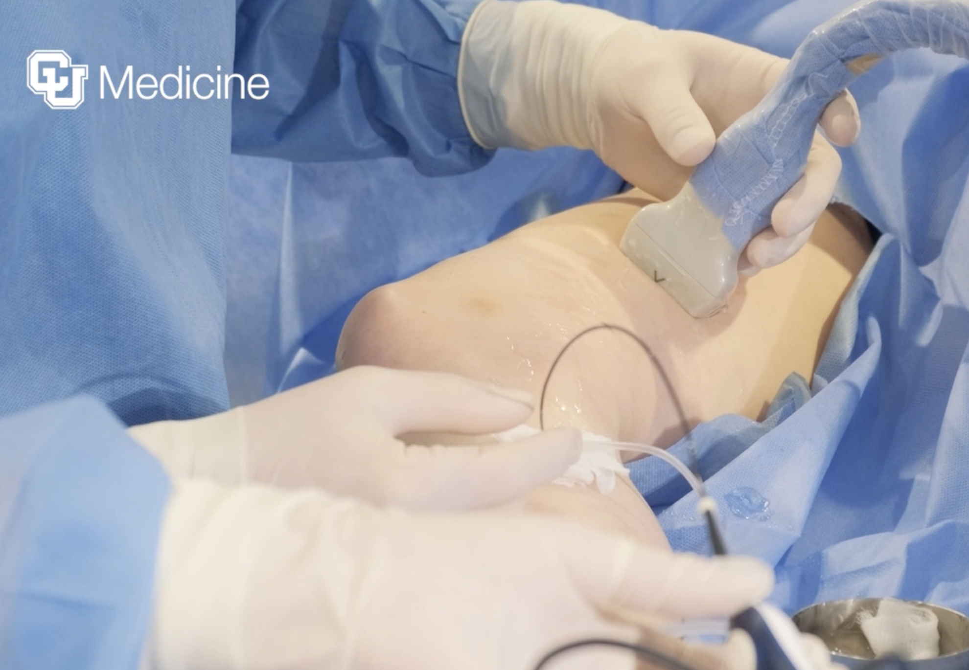 endovenous-treatment
