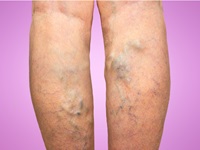 varicose veins